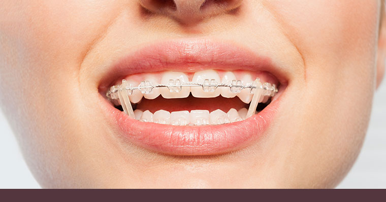 Teenager wearing rubber bands for braces - a part of Chatham Orthodontics