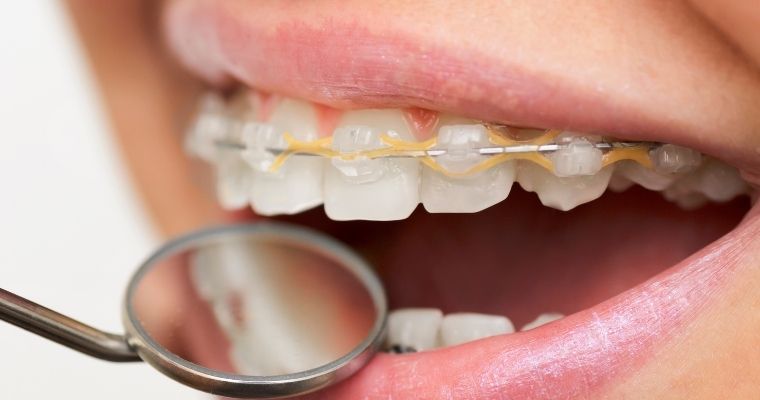 White Spots on Teeth: What Are They? And How to Avoid Them?